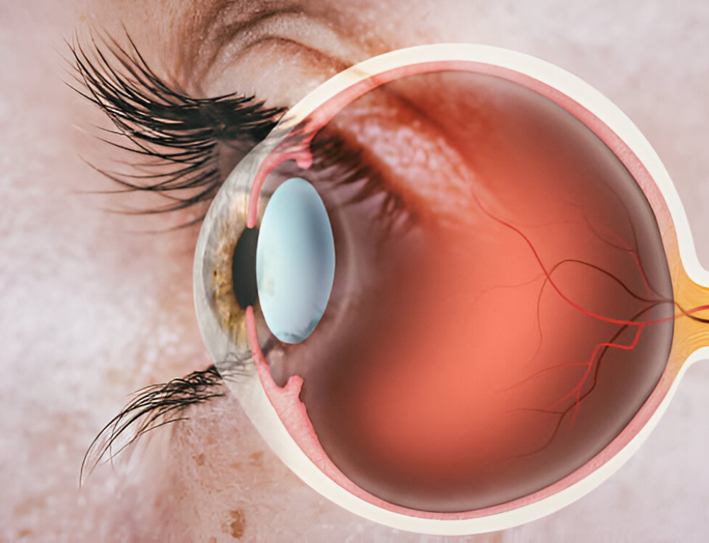 Diabetic retinopathy treatment in Undri Pune