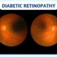 The Connection Between Diabetes and Vision: Managing Diabetic Retinopathy