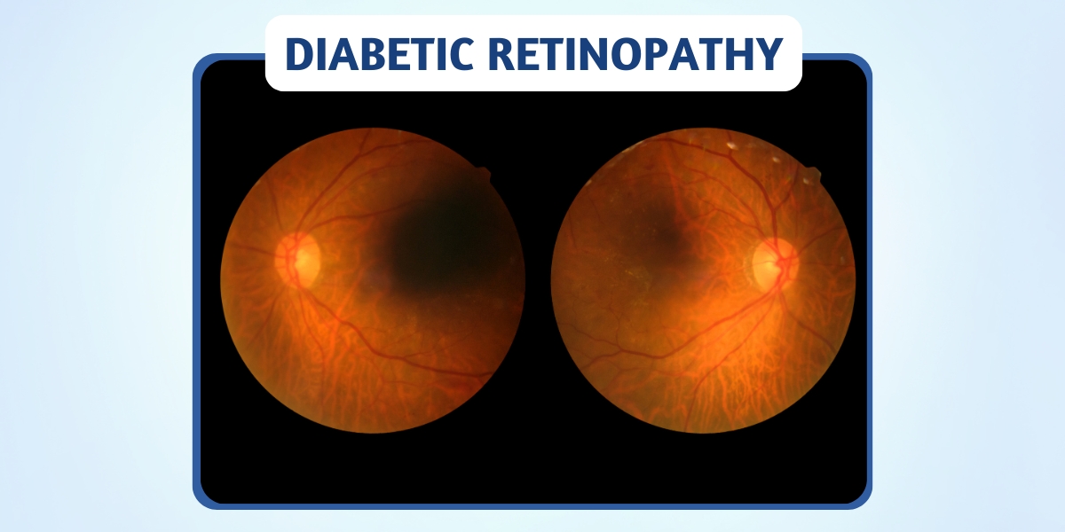 The Connection Between Diabetes and Vision: Managing Diabetic Retinopathy