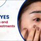Dry Eyes - Causes and Effective Treatments