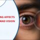 Smoking and eye health How Smoking Affects Eye Health and Vision