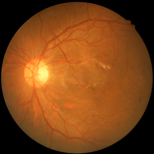 Diabetic Retinopathy Treatment