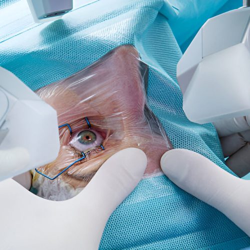 Cataract Surgery