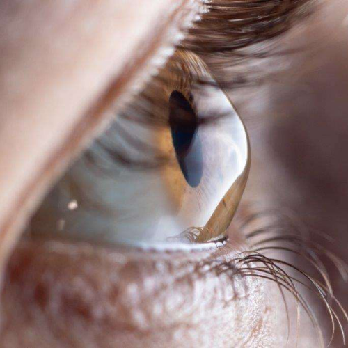 Keratoconus Treatment in Undri, Pune