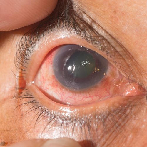 Glaucoma Treatment in Pune